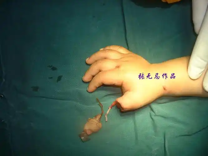 原创2岁5个月拇甲瓣游离移植拇指再造术