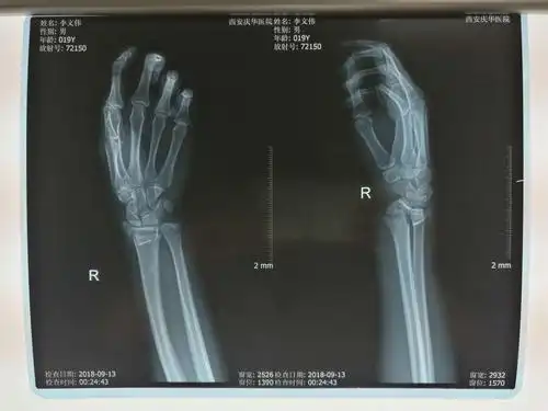 右侧桡骨远端骨折