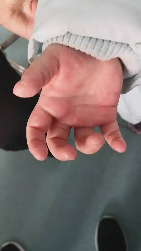 儿童手掌汗疱疹