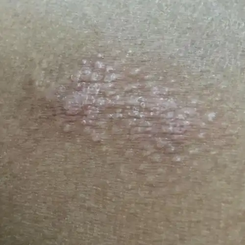 胳膊上起了个癣,这是什么癣,要搽什么药?谢谢