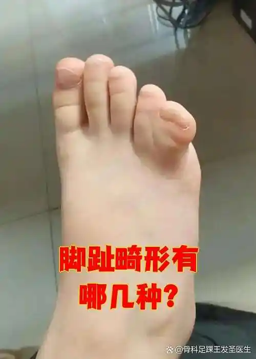 常见的脚趾畸形包括多趾畸形,并趾畸形,巨趾畸形,锤状趾和杵状趾等