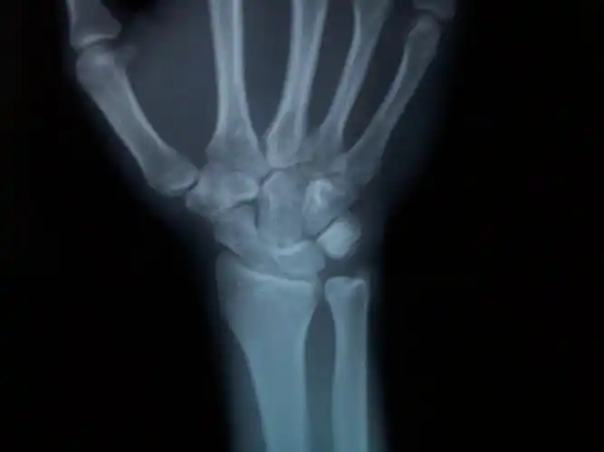 骨科专家进~~关于下尺桡关节脱位