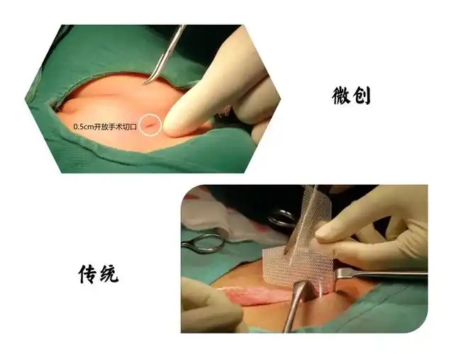 在疝气"洞洞"前放置高分子材料的补片,就能巧妙手术,患者通常术后一天
