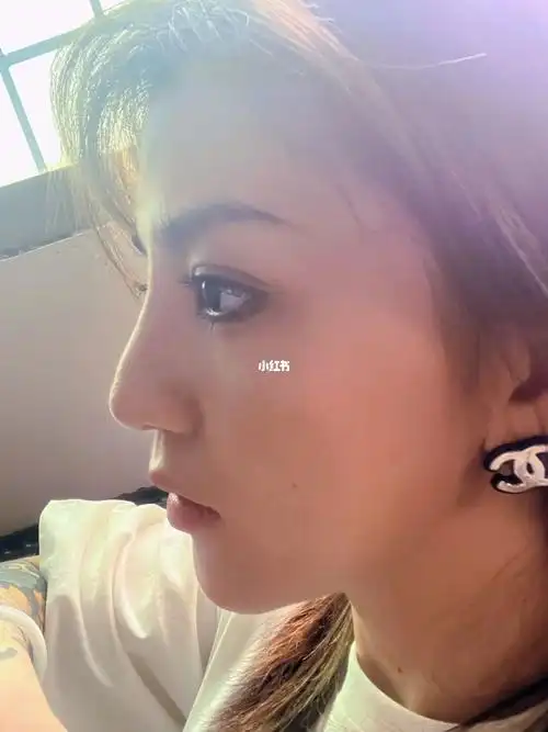 鼻尖下旋通天鼻想做鼻子广州有推荐的医生吗……#容貌焦虑#鼻子  #想