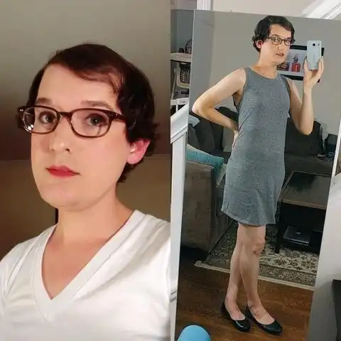 秃男记录一年吃雌激素变化 头发长了,变女生了