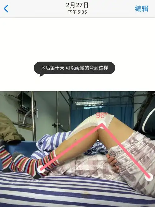 左膝胫骨平台骨折day33几乎可以全角啦