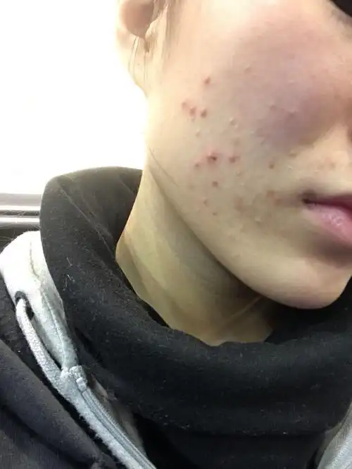 2017-12-05 21:11   最佳答案 闭合性粉刺,丘疹性痘痘,你肠胃好不 ??