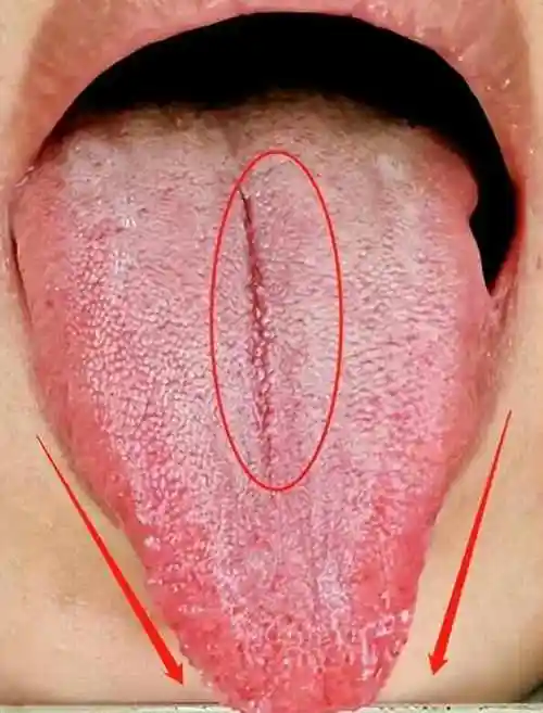 有鼓胀,这就是肝气郁滞了,导致气血无法向外疏散,致使舌头收缩不舒展