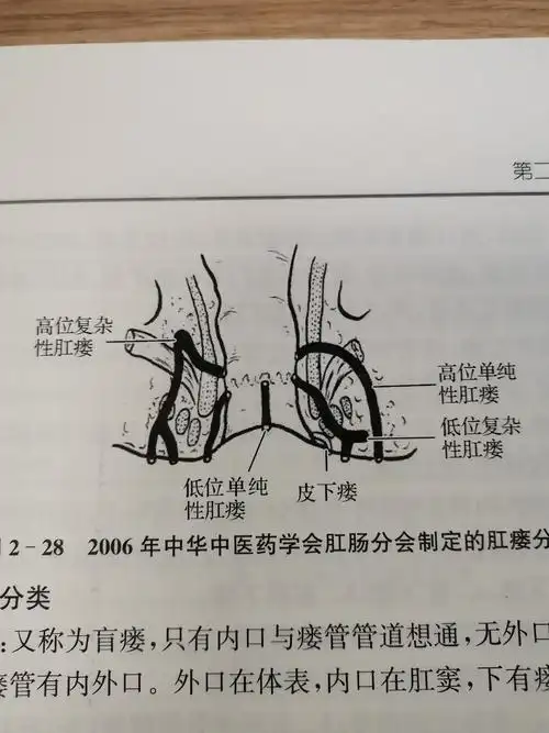 肛周脓肿肛瘘的发生,发展示意图 - 好大夫在线