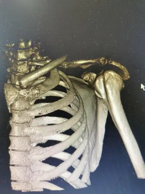 左锁骨骨折一例