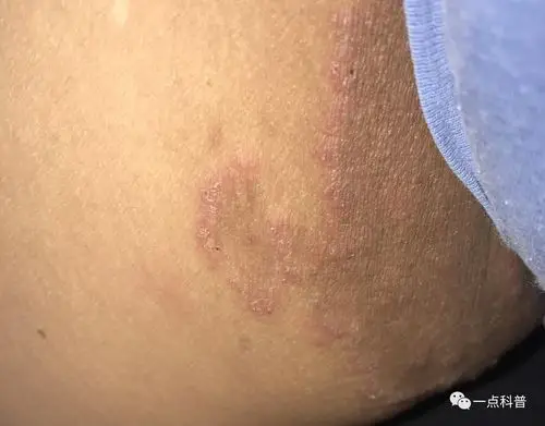 他是大腿根部的皮疹,脱掉内裤以后可以分明看到境界比较清楚的红斑