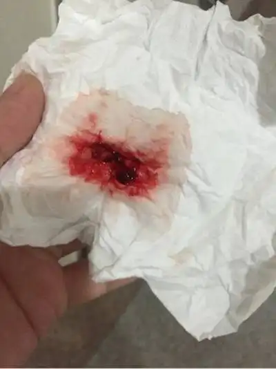 吐血图片 (25)_有来医生