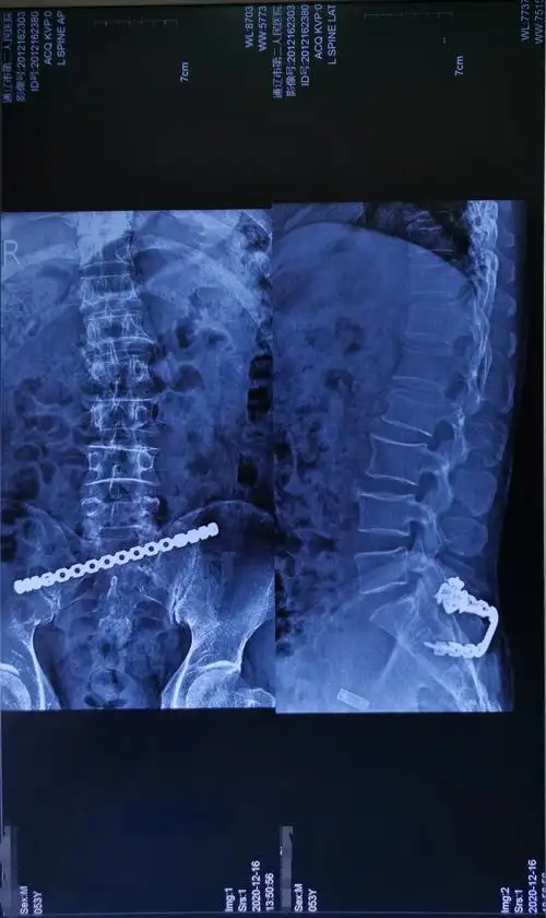 54岁腰椎压缩性骨折切开复位椎弓根内固定手术一例