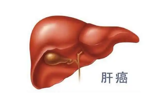 肝癌不痛也不痒发现就是晚期身体这6个症状要去医院检查了