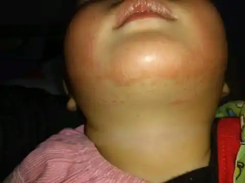 宝宝口水疹该怎麼办?