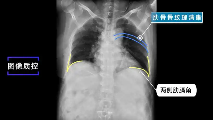 x线规范化检查膈上下肋骨摄影视频及图文详解