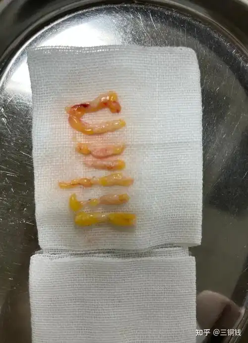 手术切除的标本为长条形,黄色为脂肪,白色为乳房肿物组织手术切除的