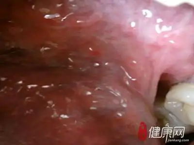 尖锐湿疣初期图片女