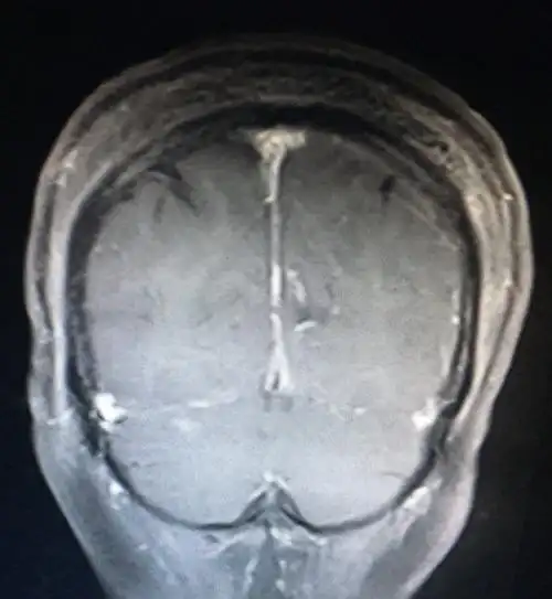 枕部大脑镰良性脑膜瘤 - 好大夫在线