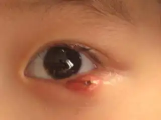 宝宝下眼睑起了一个疙瘩