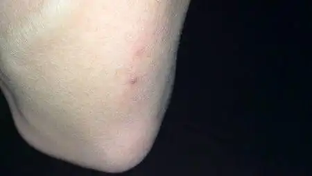 皮肤长了好多黑色凸起包点,硬硬的,刚开始是从脚开始长,过了三个月