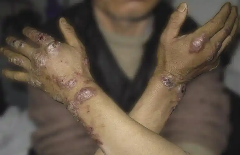 皮肤性病科图谱皮肤血管炎持久性隆起性红斑