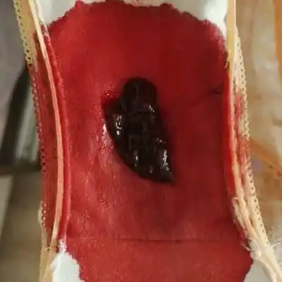 今天下面突然就出鲜红色血液