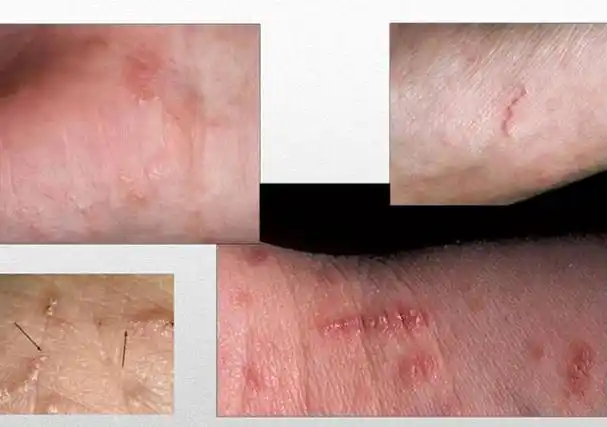 疥疮长什么样子疥疮初期的小红点图片疥疮早期症状图