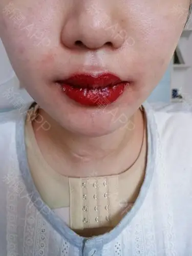 半永久纹唇好不好_效果图_术后当自强半永久纹唇术后第3天_新氧美容