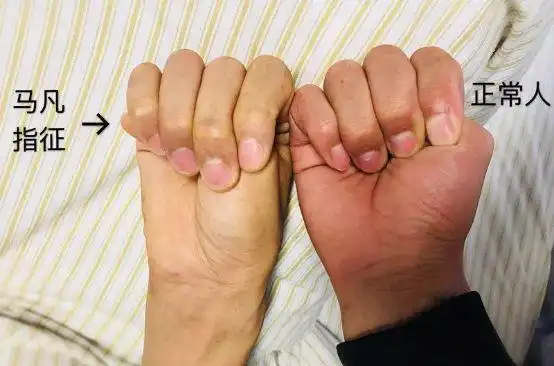 "天才"体型的隐患,居然是._马凡氏