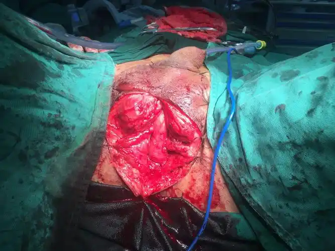 介绍几例近期的手术