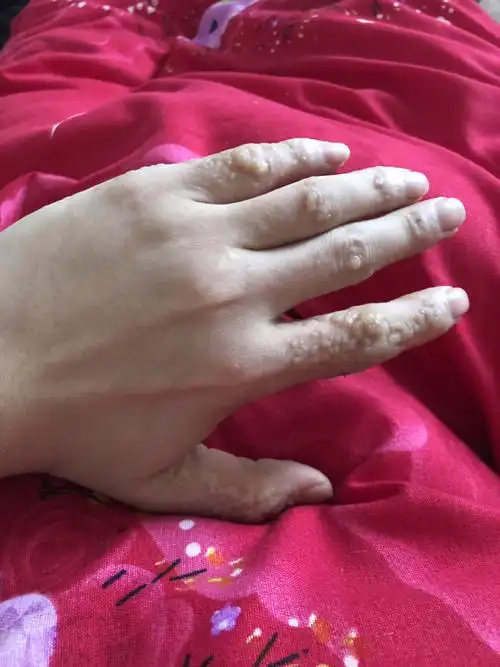 罕见的皮肤病 不是水泡,全是肉疙瘩.