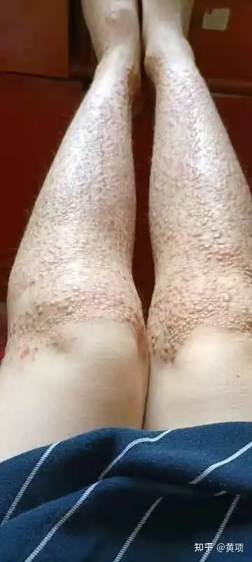 皮肤淀粉样变怎么治