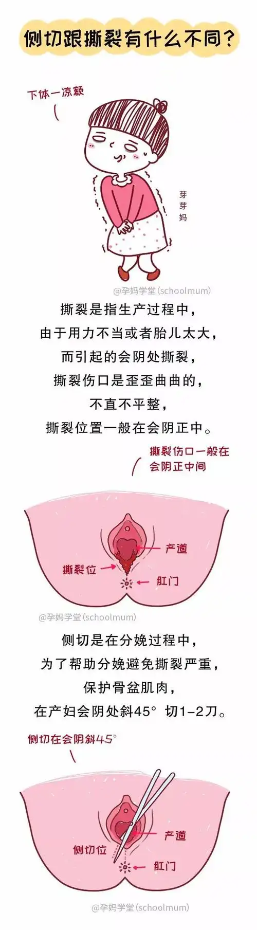 答01顺产就一定要侧切吗?