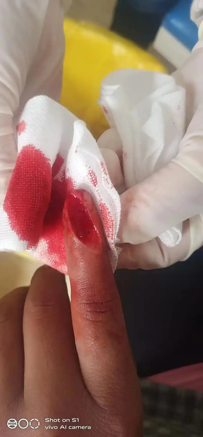 医生说缝了就会疼三天三夜[苦涩]叫我很疼的时候干一杯酒说[撇 - 抖音