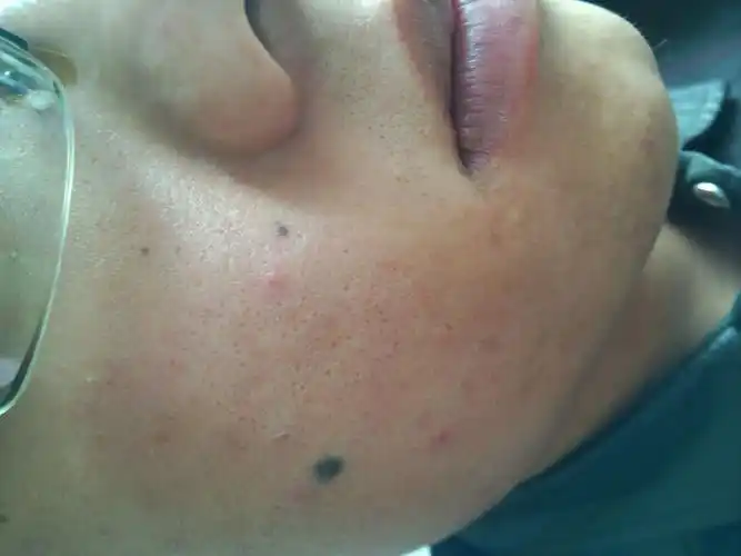 我的皮肤该怎么救,还有很多黑点,应该是用手挤痘痘留下的