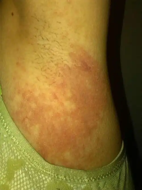 最近腋下起了一片红色疹子,痒,不知道什么原因引起的