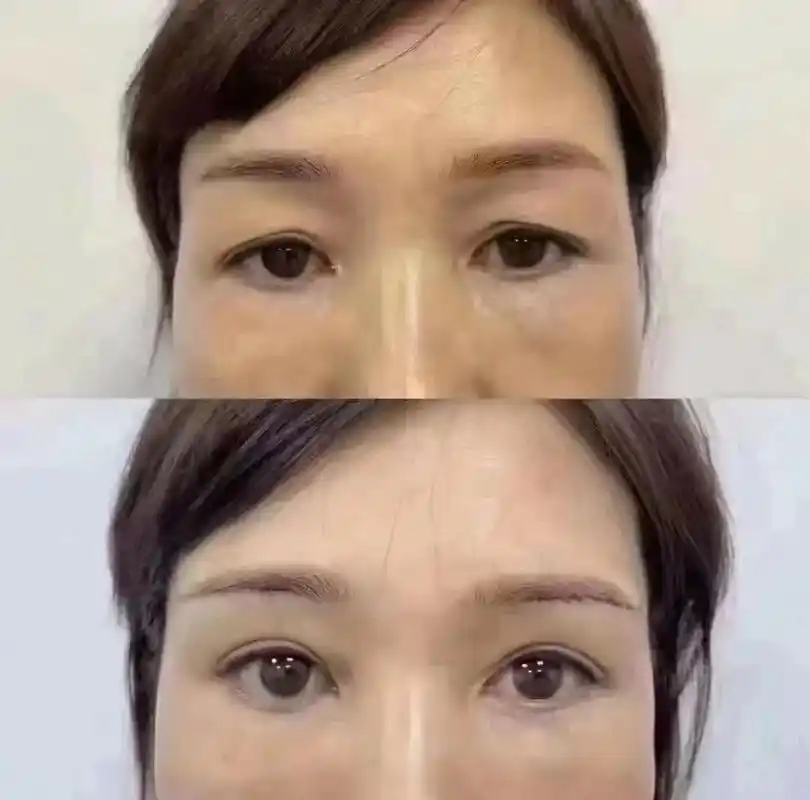 提眉去眼袋前后的对比照片即刻让你减龄十岁多