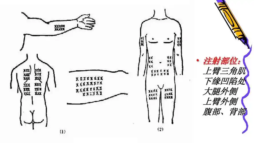 注射部位: 上臂三角肌 下缘凹陷处 大腿外侧 上臂外侧 腹部,背部