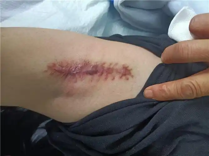 禄丰市人民医院皮肤科成功开展腋臭微创清除术_云南经