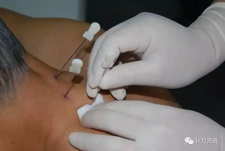 针刀治疗颈椎病的新思路