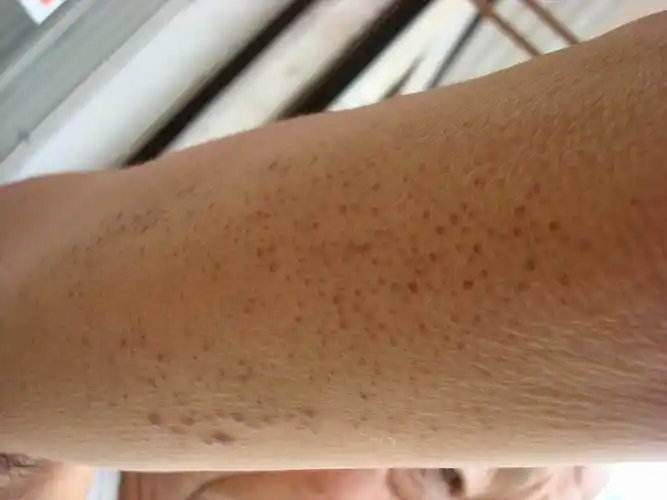 看图诊断18……毛周角化病