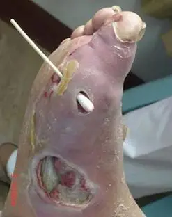 糖尿病足诊断与治疗