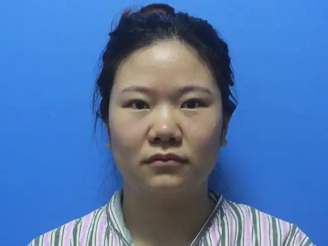 术前:蒜头鼻,鼻根低平,鼻头,鼻翼肥大,鼻翼,鼻孔_圈子-新氧美容整形