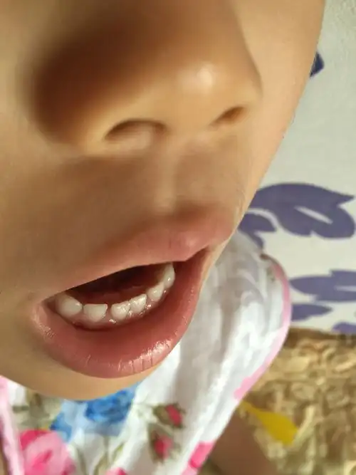 小女孩又长出一排牙是怎么回事?