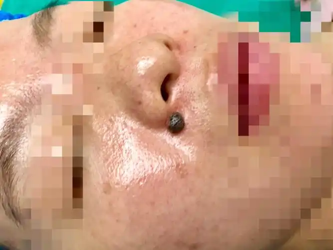 黑毛痣切除术术式选择 - 好大夫在线