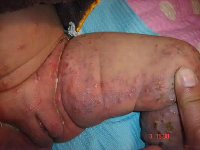 色素失禁症红斑水疱期