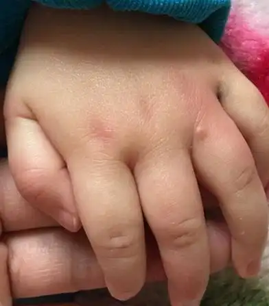 宝宝手上长水泡了,一张图区分是不是水痘