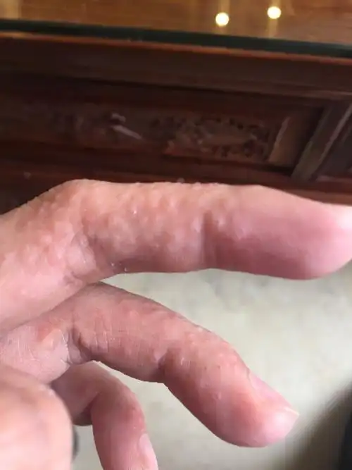 为什么只要擦风油精,手指就会长小水泡还特别痒