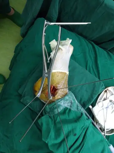 是全身最大的跗骨,在跗骨骨折中发病率最高,多由高处坠落足跟着地所致